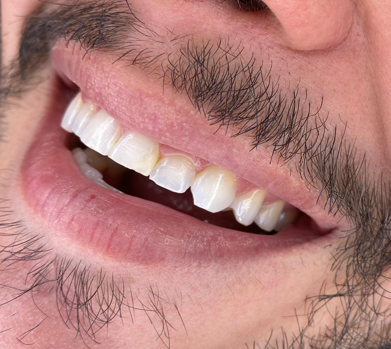 2 – Antes 2 - Antes