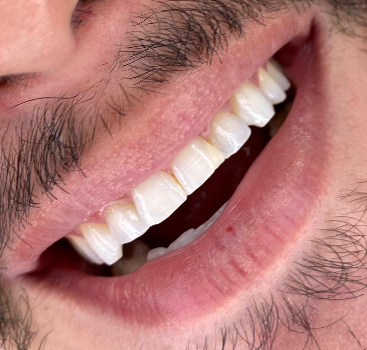 3 – Antes 3 - Antes