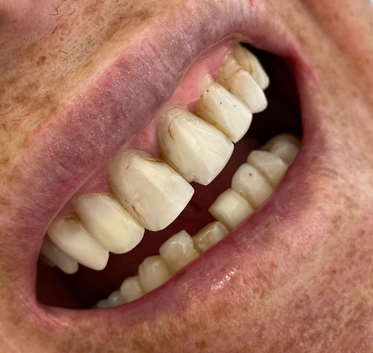 4 – Antes 4 - Antes